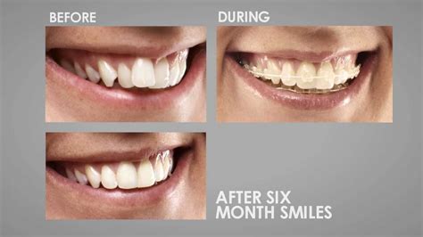 six months smiles metal bracket rebond|Six Month Smiles.